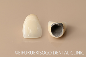 メタルボンドクラウン