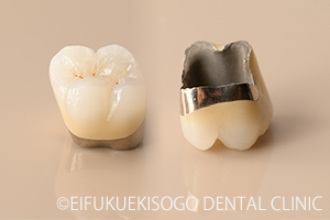 メタルボンドクラウン