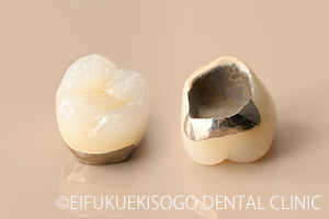 ハイブリッドレジンクラウン