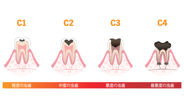 むし歯の進行
