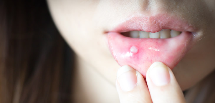 口内炎