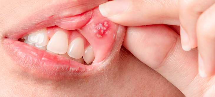 アフタ性口内炎