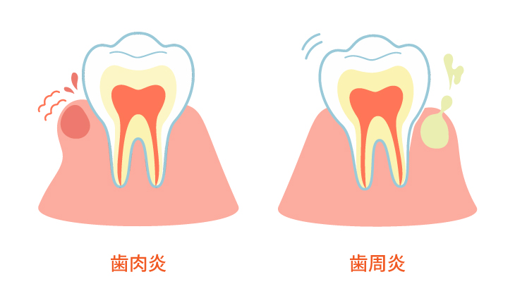 歯肉炎から歯周炎