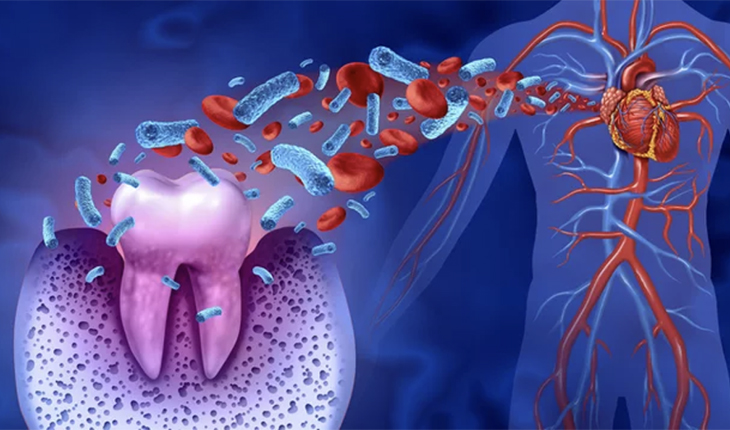歯周病と全身疾患