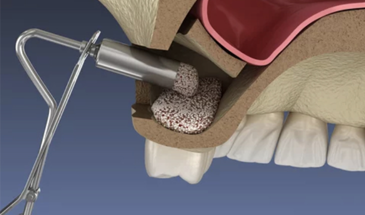 サイナスリフト