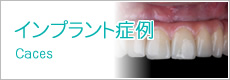 インプラント症例