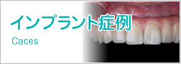 インプラント症例