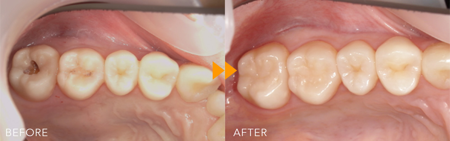 保険CR治療の症例