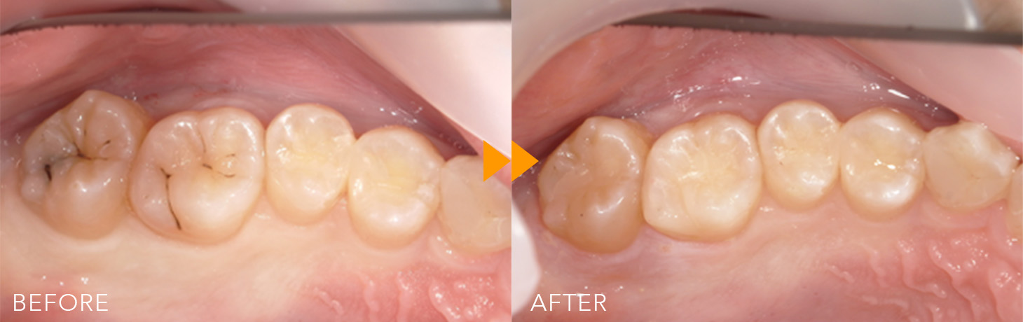 保険CR治療の症例