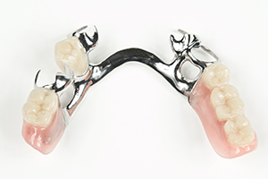 パーシャルデンチャー