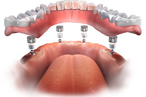 マグネット付き入れ歯