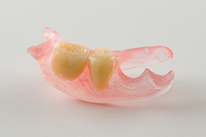 金属バネなし入れ歯