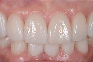 オールセラミック