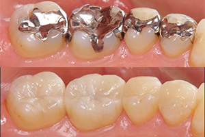 銀歯との比較画像