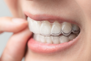 マウスピースの取り外し