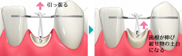 エクストルージョン