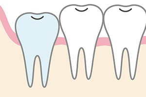 まっすぐ生えた親知らず