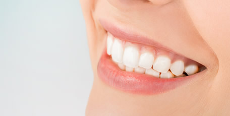 セラミック矯正